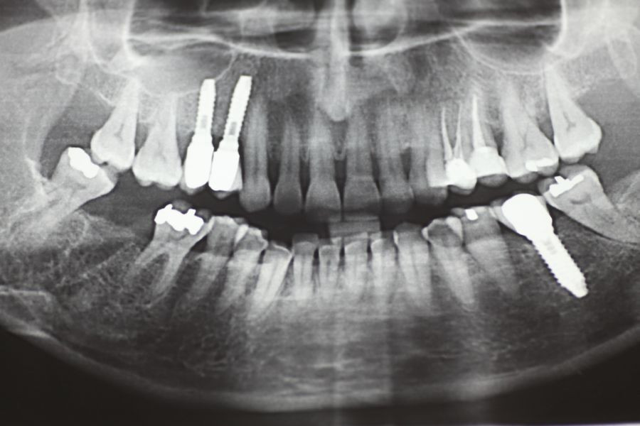 Utilización del láser en el tratamiento de la osteonecrosis de los