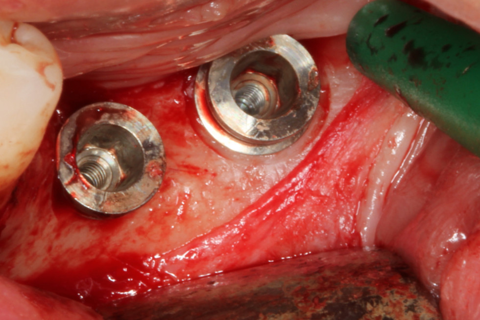 Fig. 1. k) Implantes colocados.