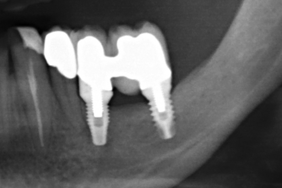 Figura 7. Realización de rehabilitación definitiva sobre implantes una vez integrado el segundo implante colocado sobre la zona regenerada con el injerto en bloque.