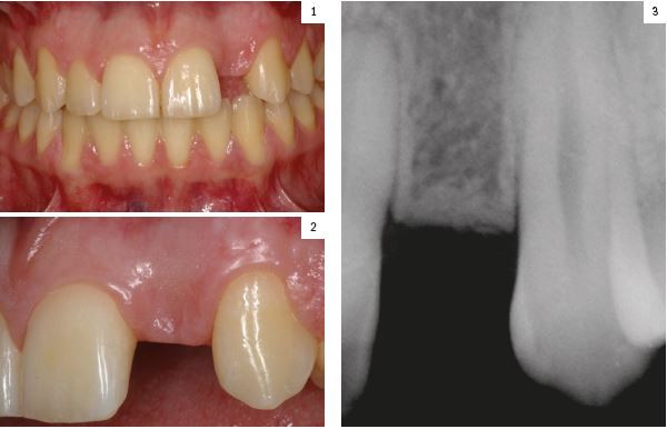 Figuras 1-2. Imágenes iniciales de la paciente donde podemos observar la ausencia de un incisivo lateral izquierdo con un espacio mesio-distal protésico ligeramente reducido. Figura 3. Con la radiog