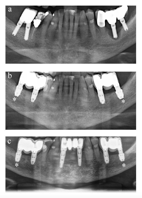 Figura2_CasoAnitua_implantología_DM53