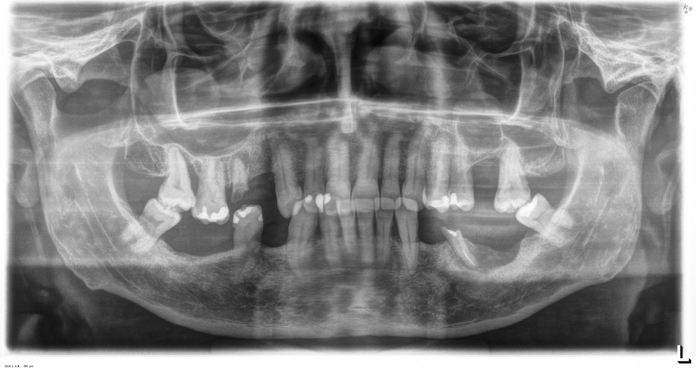 figura 3_caso_anitua_implantología_DM57