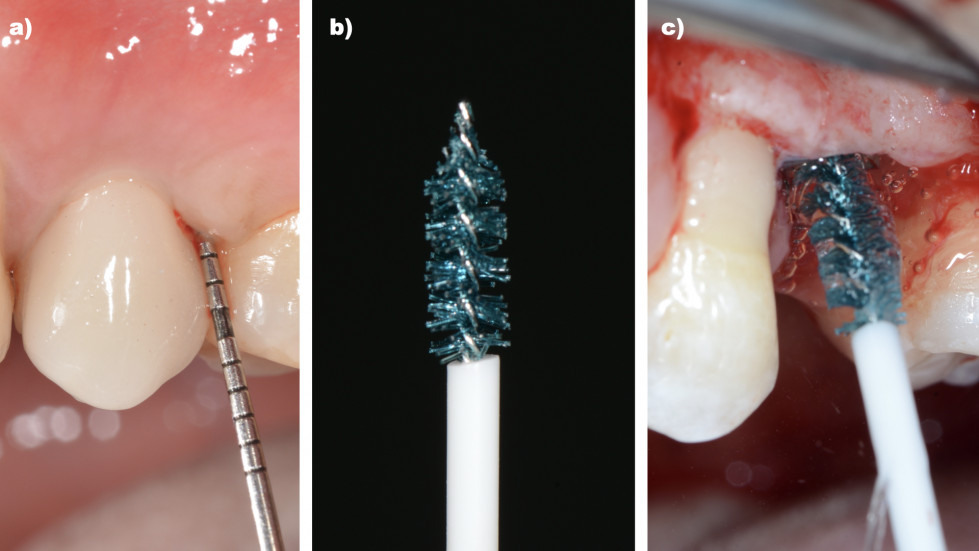 Figura8_CasoImplantología_DM57_Descontaminación_implantes_Dr.Regidor