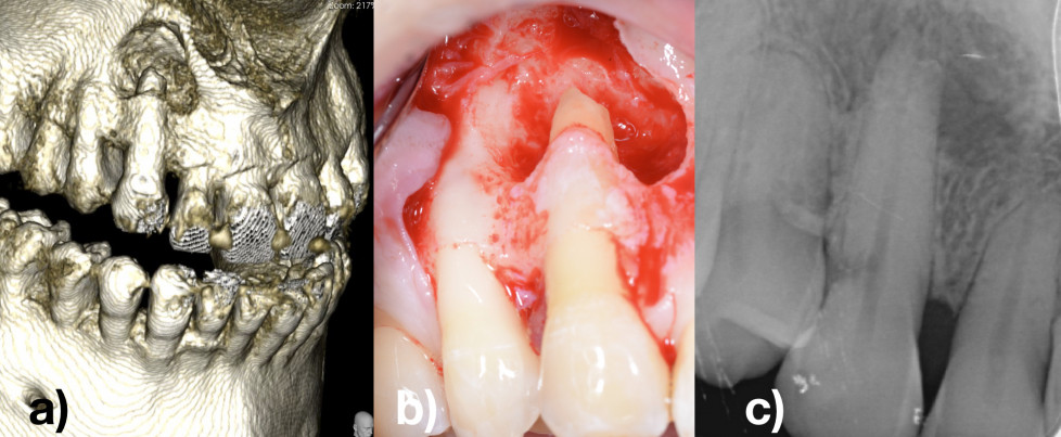 Imagen Figura 8 correspondiente al caso de Periodoncia Multidisciplinar titulado 