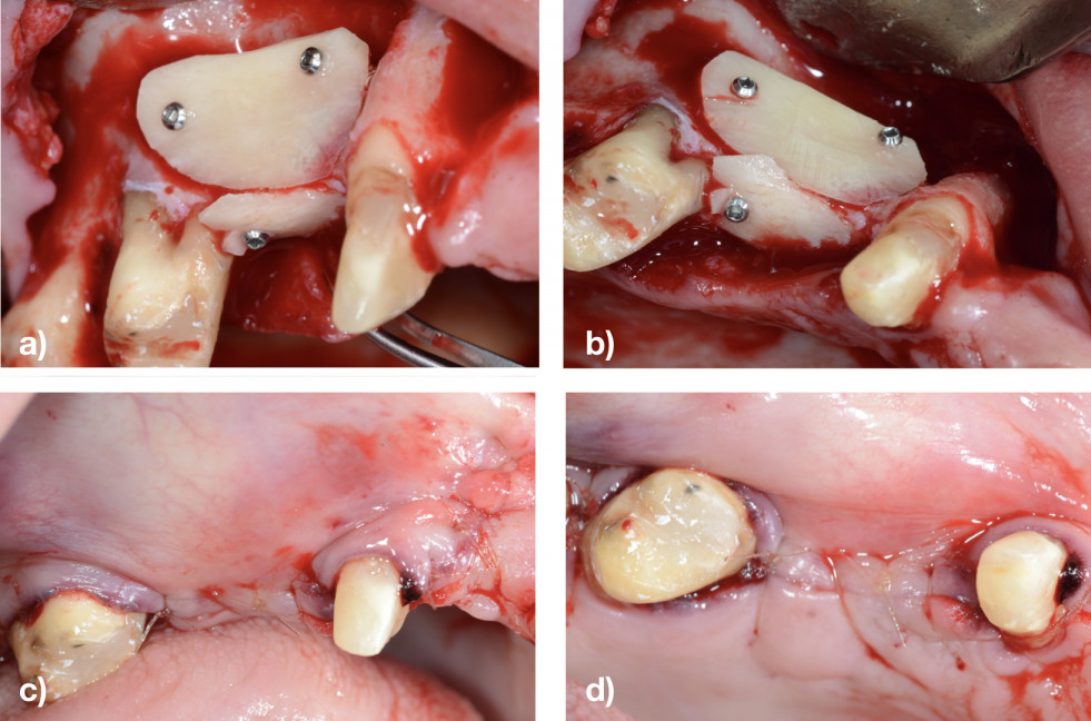 Figura 5. a) Imagen vestibular de las láminas autónomas fijadas. b) Imagen oclusal de las láminas autónomas fijadas. c) Imagen vestibular de la sutura. d) Imagen oclusal de la sutura. FOTO: Grupo 