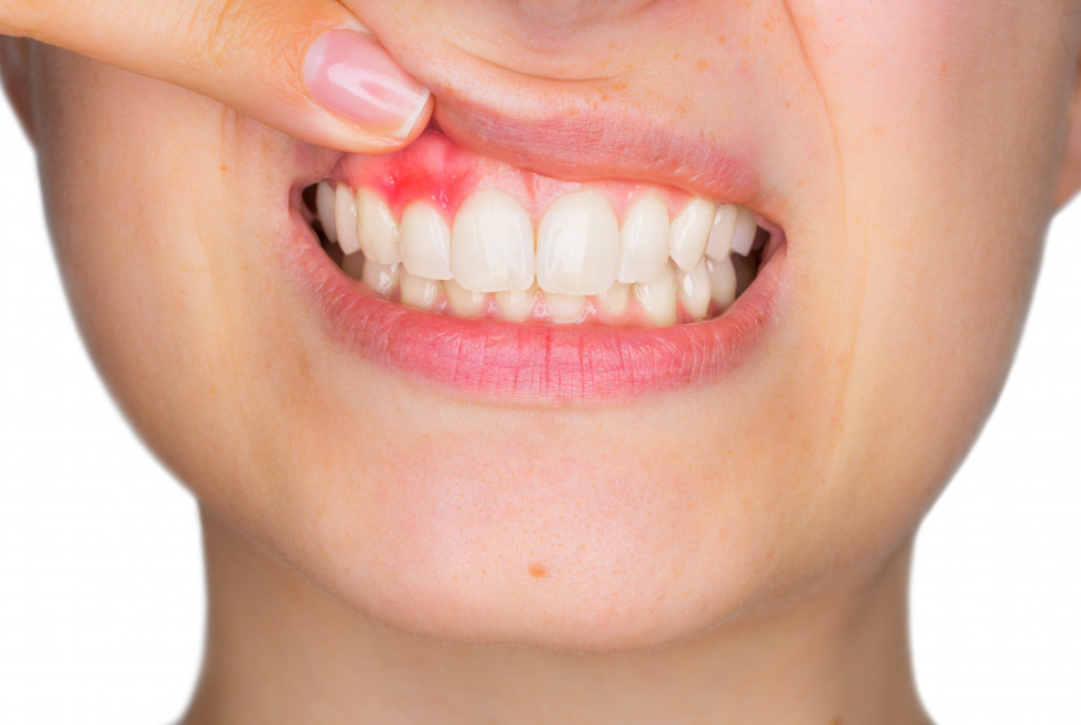 APERTURA Bleeding and sensitive gums