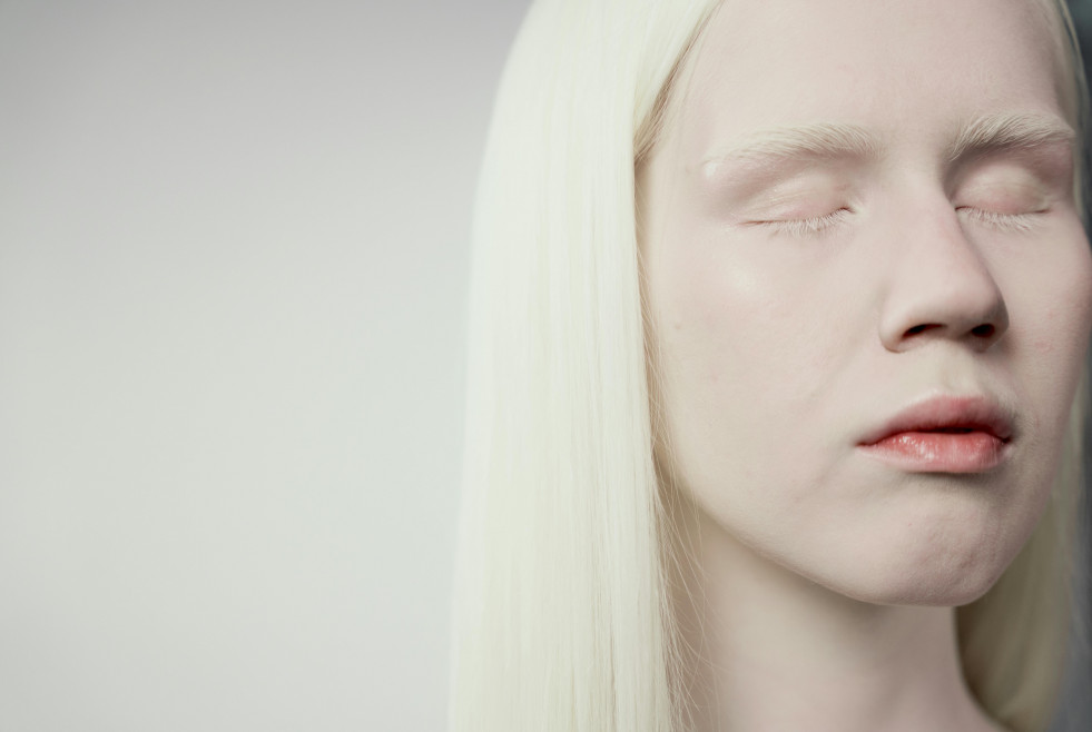 Albinismo pexels cottonbro 10210352