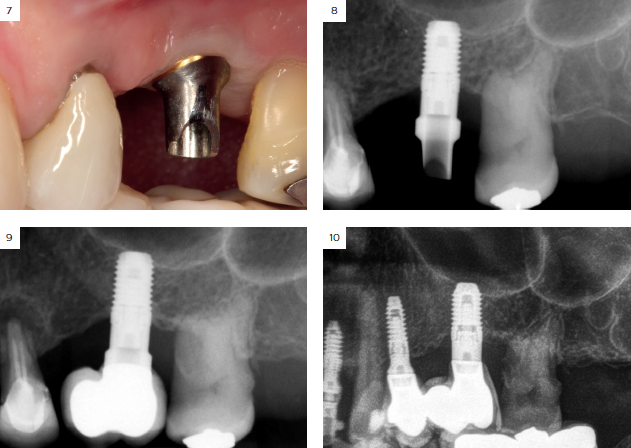 Figuras7 10 caso implantologia Anitua dm88