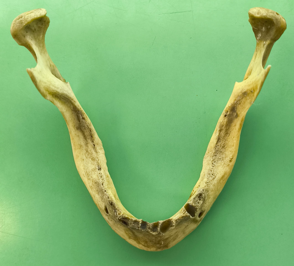 Mandibula humana que muestra un foramen retromandibular