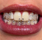 Toothgems